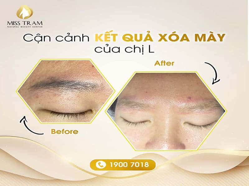 Kết Quả Xóa Mày Của Chị L An Toàn