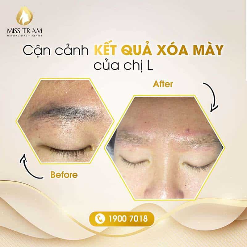 Cận Cảnh Kết Quả Xóa Mày Của Chị L