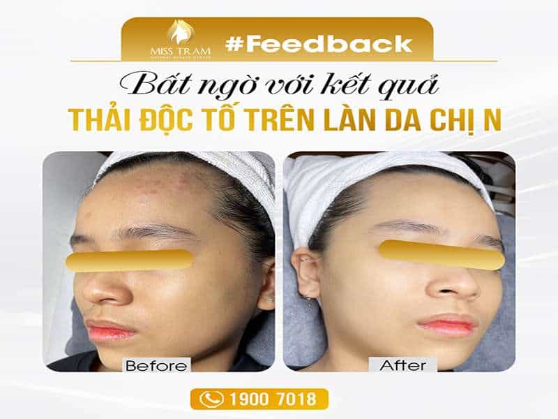 Kết Quả Thải Độc Tố Trên Làn Da Chị N