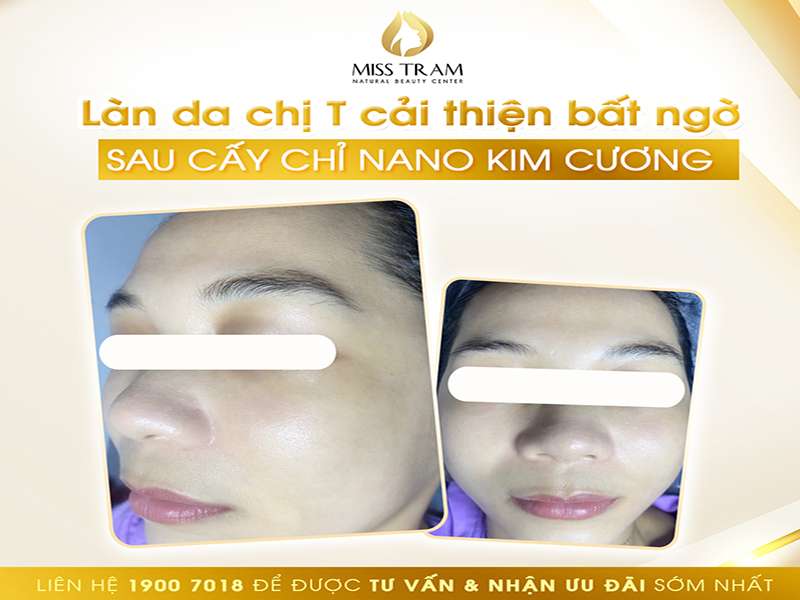 Kết Quả Sau Chạy Chỉ Nano Kim Cương Của Chị T
