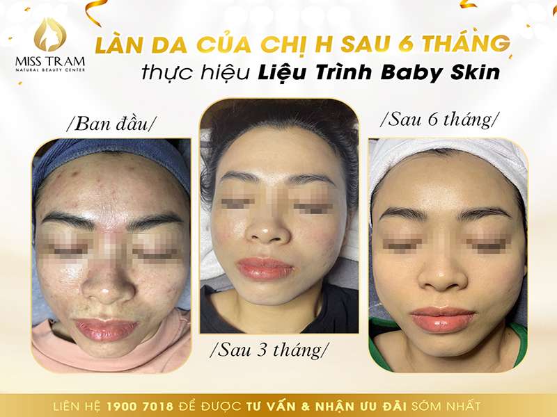 Làn Da Của Chị H Sau 6 Tháng Thực Hiện Liệu Trình Baby Skin
