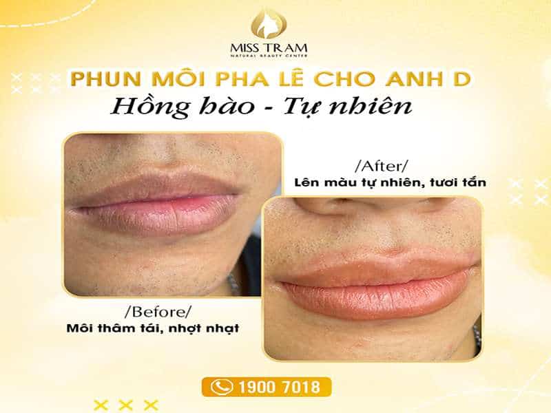 Chiêm Ngưỡng Kết Quả Phun Môi Pha Lê Cho Anh D