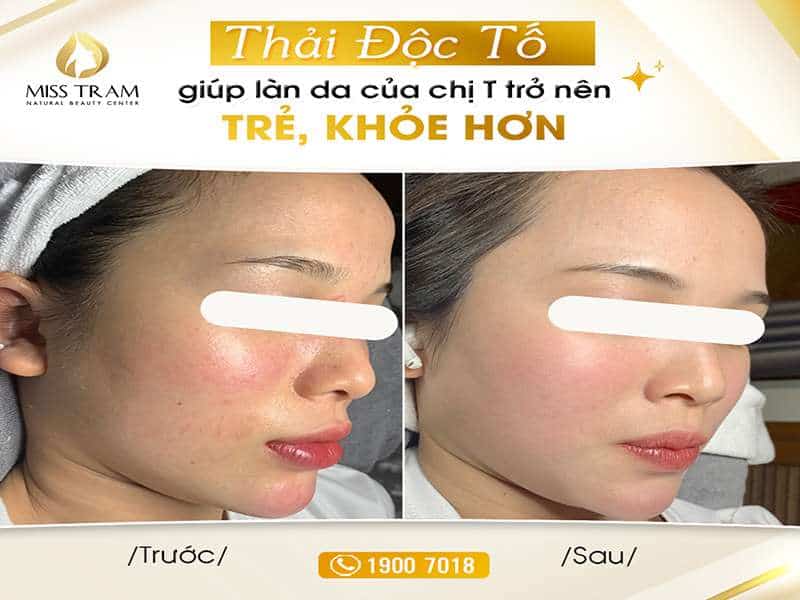 Kết Quả Thải Độc Tố Làn Da Của Chị T