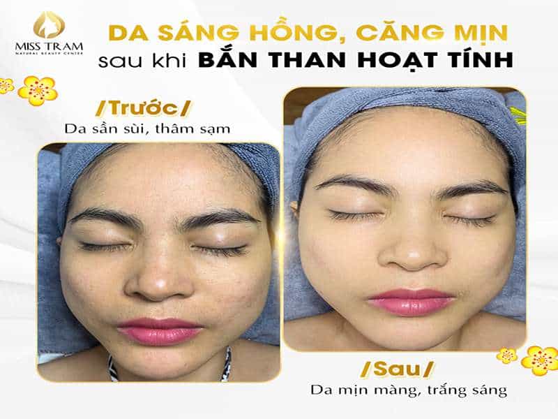 Ngắm Làn Da Chị H Sáng Mịn Sau Khi Bắn Than Hoạt Tính