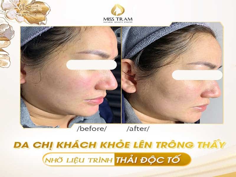 Liệu Trình Thải Độc Tố Giúp Da Sáng Khỏe Hơn Mỗi Ngày