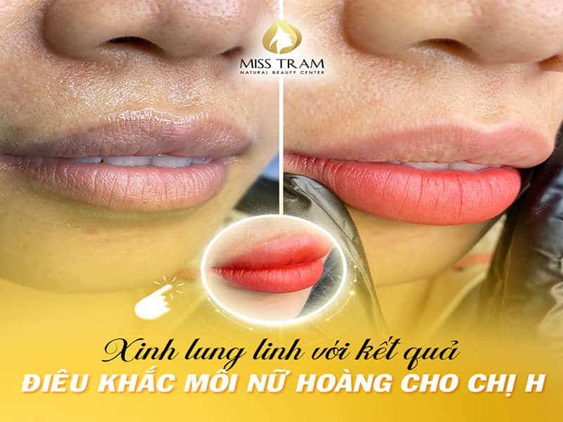 Ngắm Kết Quả Điêu Khắc Môi Nữ Hoàng Cho Chị H