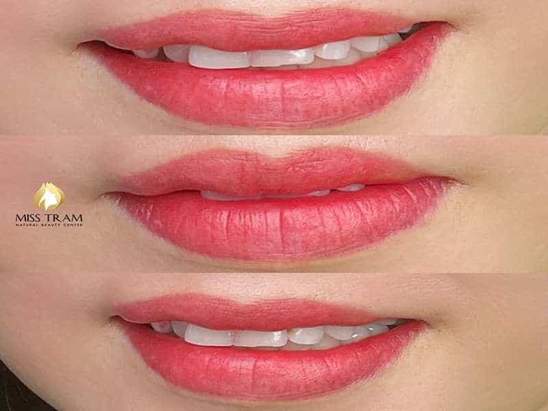 Môi Mềm Mọng, Màu Sắc Tươi Tắn – Tự Tin Với Vẻ Đẹp Mới