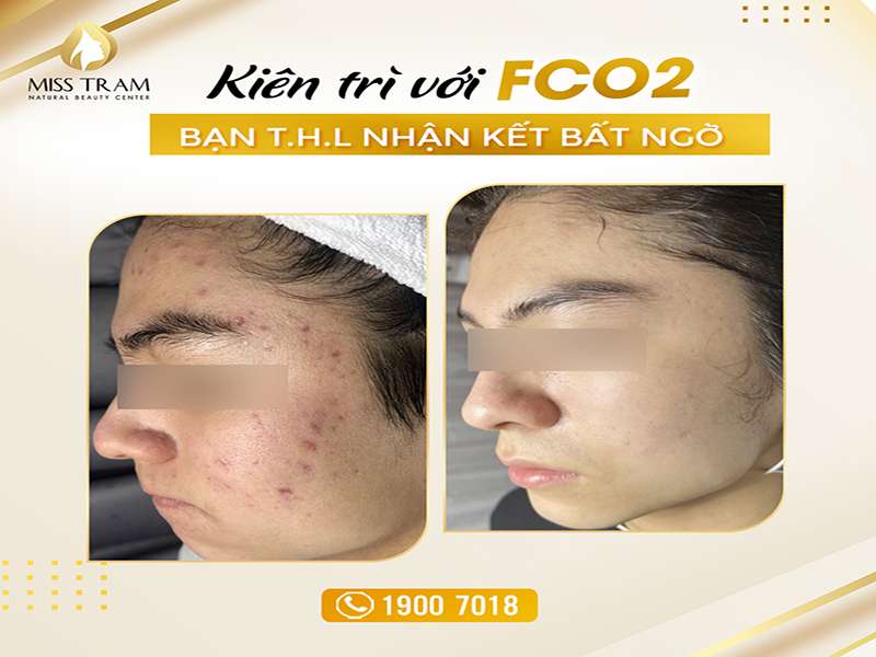 Kiên Trì FCO2, Làn Da Của Bạn T.H.L Nhận Cái Kết Bất Ngờ