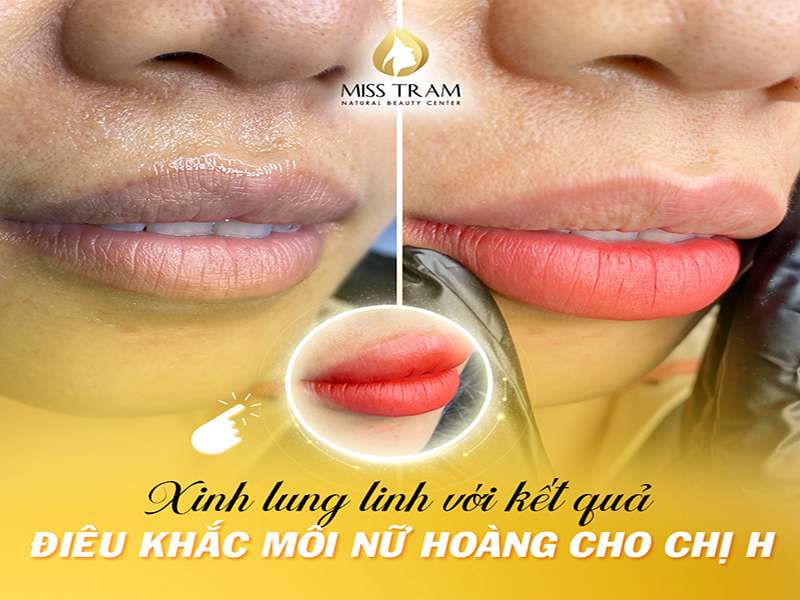 Kết Quả Điêu Khắc Môi Nữ Hoàng – Chị H Xinh Lung Linh