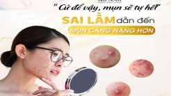 Để Vậy, Mụn Sẽ Tự Hết: Ý Nghĩ Sai Lầm Trong Chăm Da