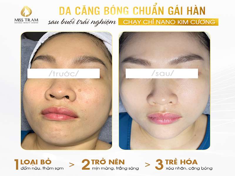 Da Căng Bóng Chuẩn Gái Hàn Sau Khi Chạy Chỉ Nano Kim Cương