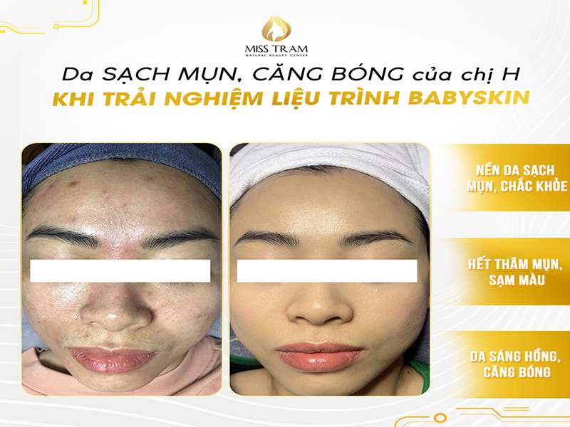 Làn Da Sạch Mụn, Căng Bóng Của Chị H Sau Liệu Trình BABY SKIN
