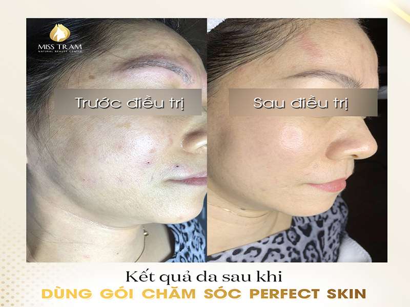 Kết Quả Da Chị Khách Sau Khi Dùng Gói Chăm Sóc PERFECT SKIN