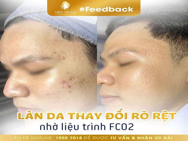 Làn Da Của Anh Khách Thay Đổi Rõ Rệt Nhờ Liệu Trình FCO2