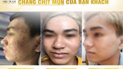 Tìm Lại Sự Tự Tin Cho Làn Da Chằng Chịt Mụn Của Khách Hàng