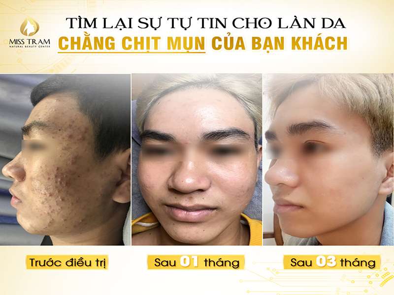 Tìm Lại Sự Tự Tin Cho Làn Da Chằng Chịt Mụn Của Khách Hàng