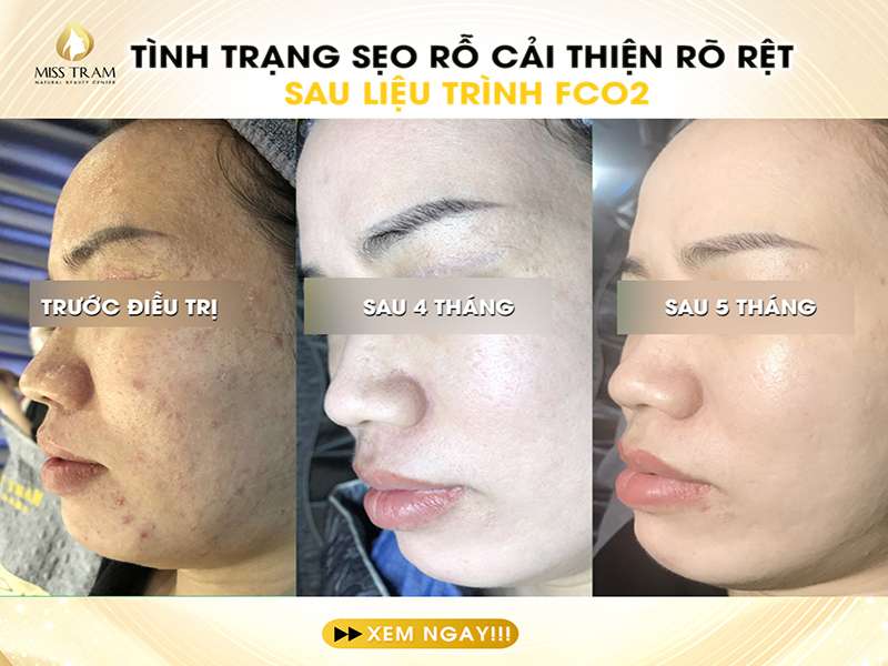 Tình Trạng Da Cải Thiện Cực Kỳ Rõ Rệt Sau Liệu Trình FCO2