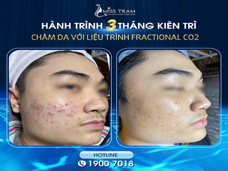 Hành Trình 3 Tháng Kiên Trì Chăm Da Với Liệu Trình Fractional CO2