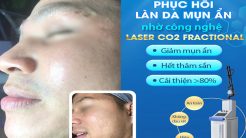 Phục Hồi Da Mụn Ẩn Nhờ Công Nghệ Laser CO2 Fractional