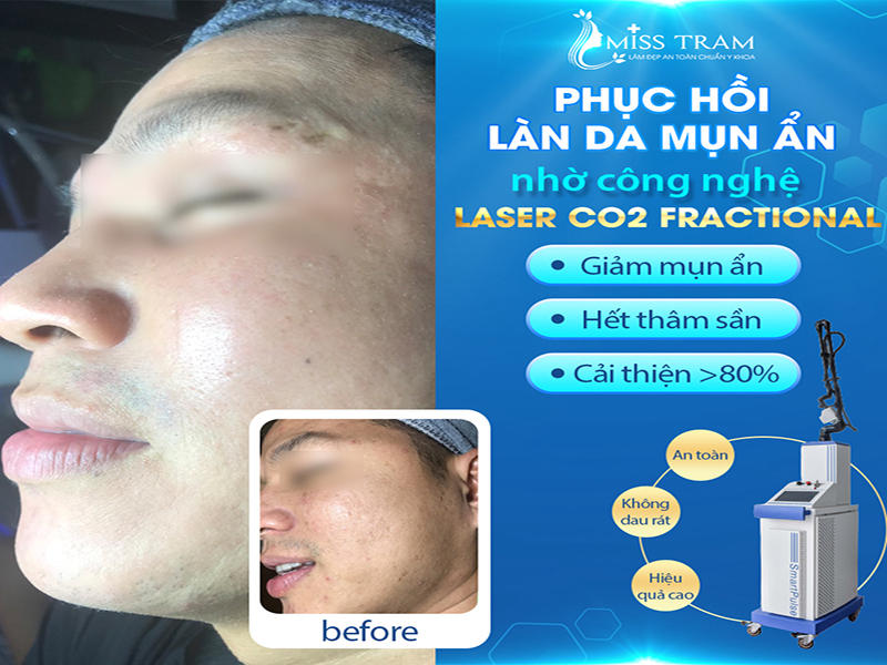 Phục Hồi Da Mụn Ẩn Nhờ Công Nghệ Laser CO2 Fractional