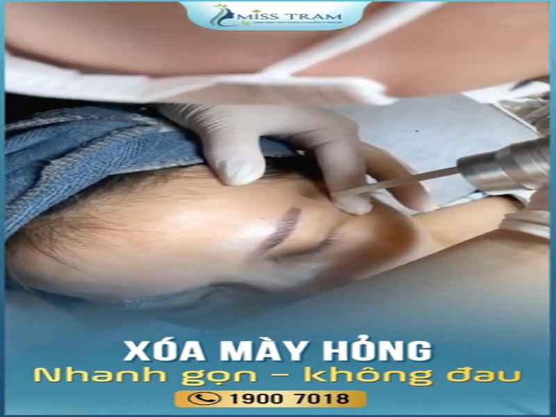 Xóa Mày Hỏng Nhanh Chóng và Không Đau Đớn 