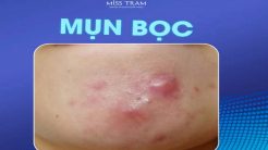 Xóa Bỏ Tự Ti Với Làn Da Sạch Mụn