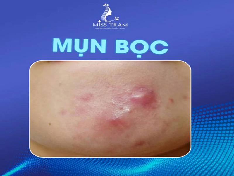 Xóa Bỏ Tự Ti Với Làn Da Sạch Mụn
