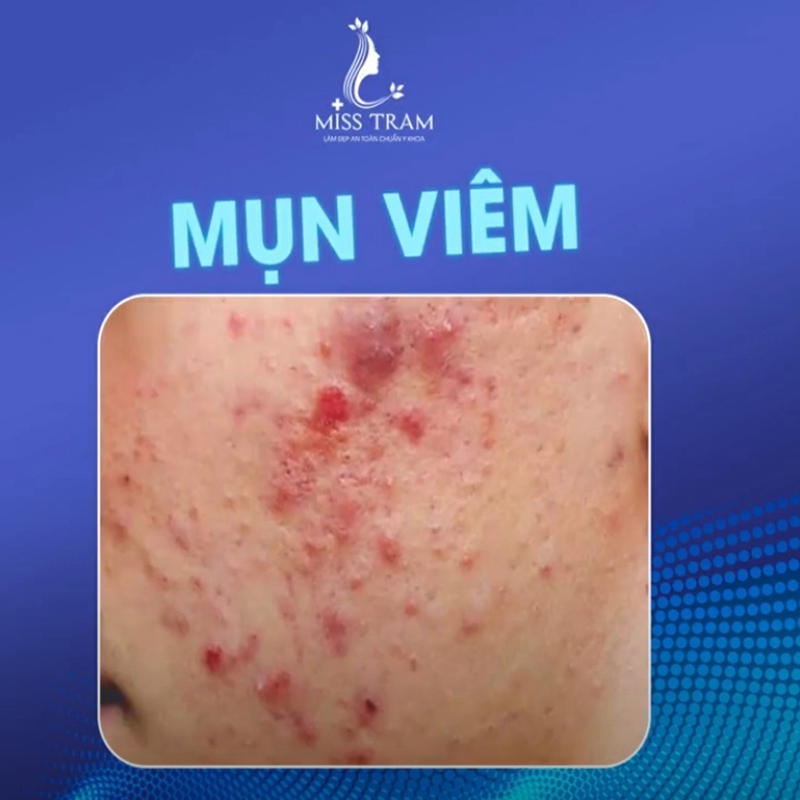 Xóa Bỏ Tự Ti Với Làn Da Sạch Mụn: