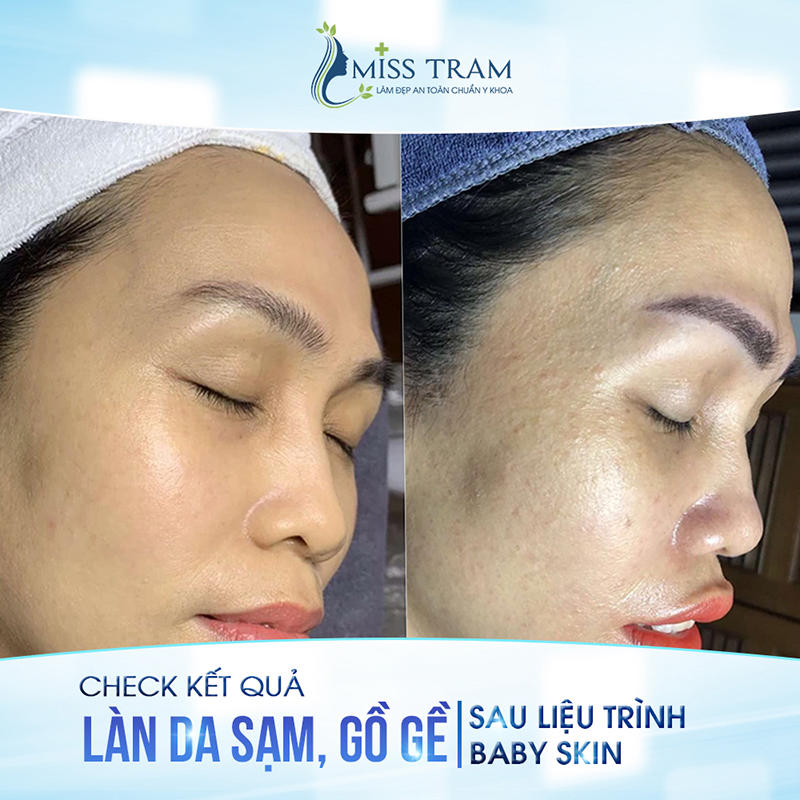 Cải thiện Tình Trạng Da Sạm, Gồ Ghề Sau Liệu Trình baby Skin 