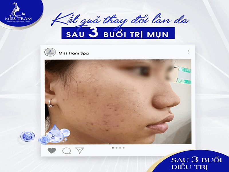 Kết Quả Thay Đổi Làn Da Sau 3 Buổi Trị Mụn