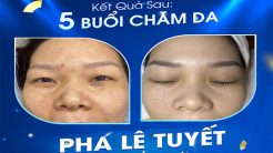 Kết quả trị mụn bất ngờ sau 5 buổi với Pha Lê Tuyết thế hệ mới X3