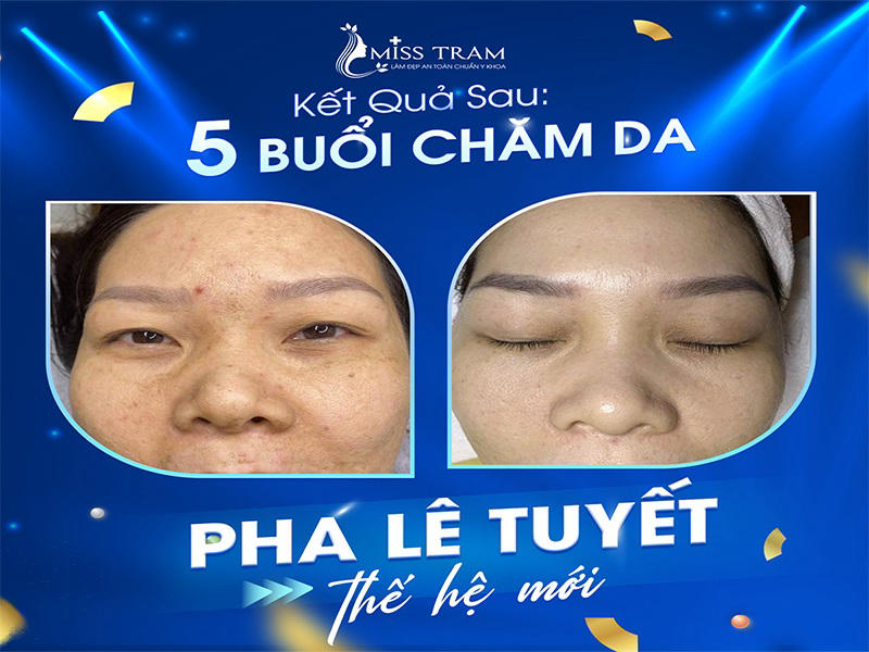 Kết quả trị mụn bất ngờ sau 5 buổi với Pha Lê Tuyết thế hệ mới X3