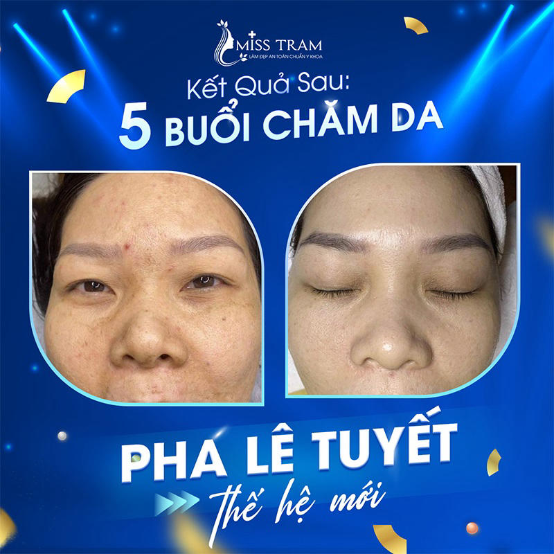 Pha Lê Tuyết X3 - Liệu trình trị mụn 5 buổi, da sạch mụn, mịn màng