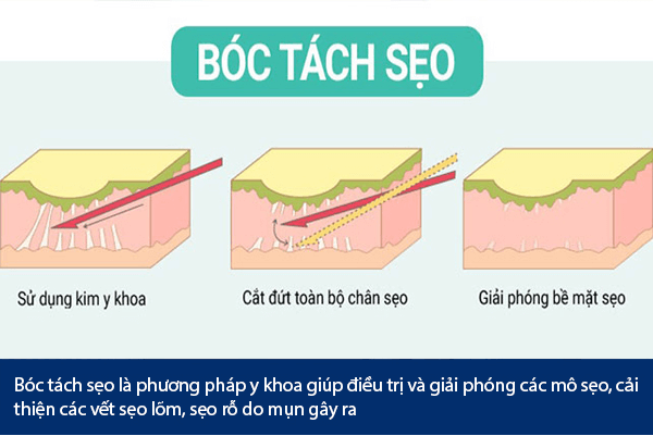 boc tach seo